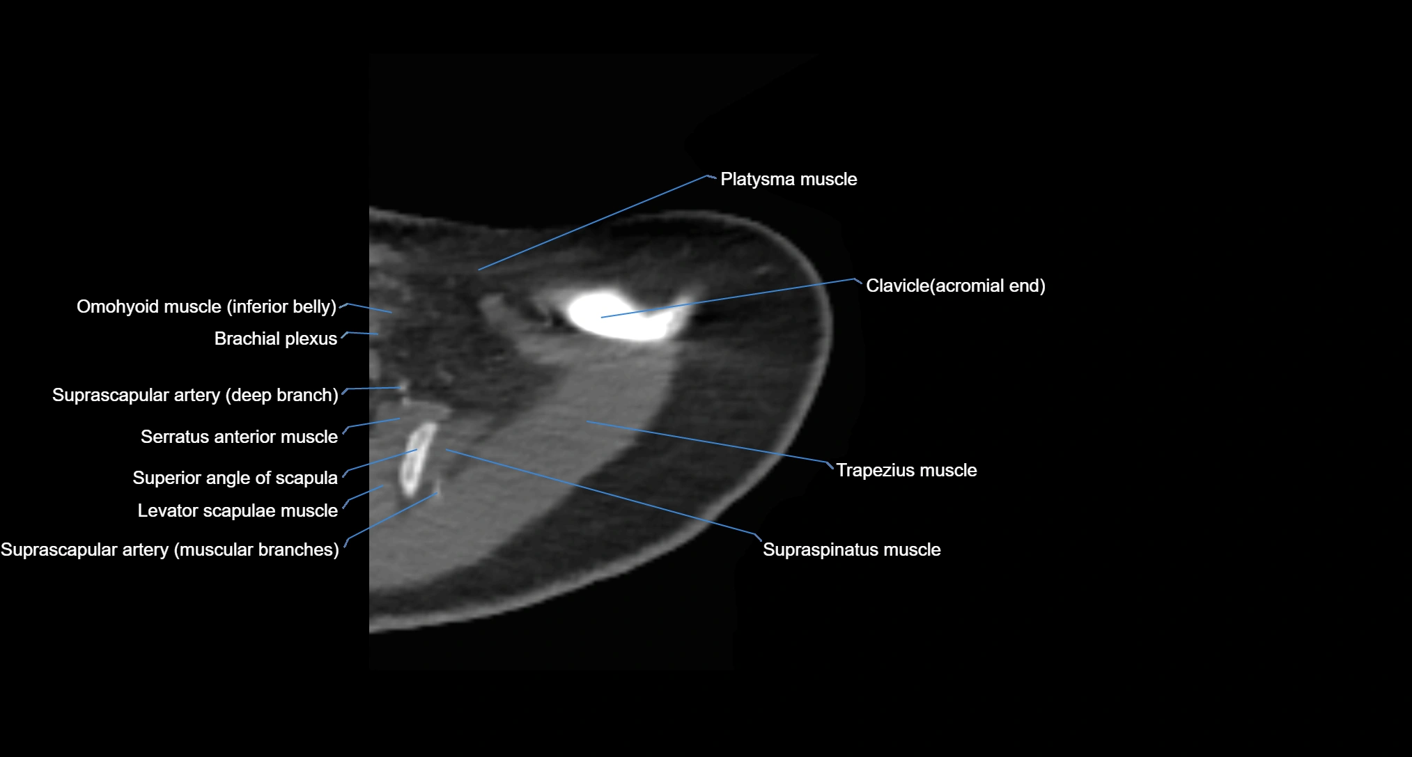 CT Shoulder axial cross sectional anatomy labelled radiology image -00011.webp